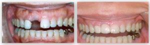 dental-implants-qa