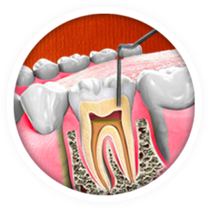 Root Canal -Dentist Near Me Huntley IL